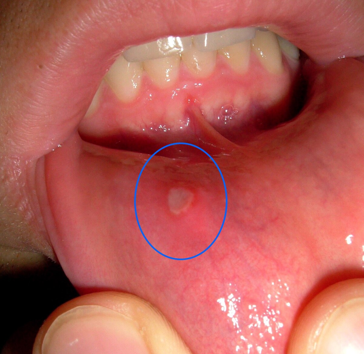 A typical canker sore with a pale center and red halo