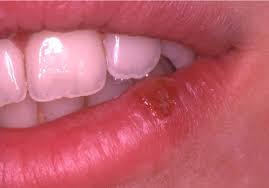 Clustered herpetic mouth ulcers after blisters rupture