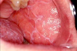 Oral lichen planus with white lacy pattern