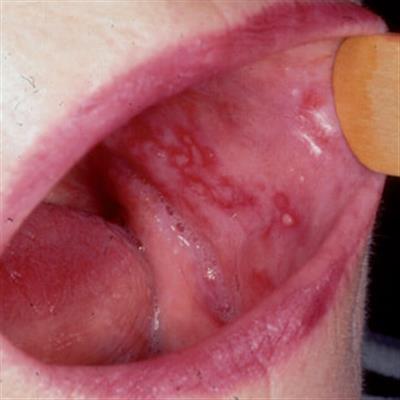 Erosive oral lichen planus with red ulcerated areas
