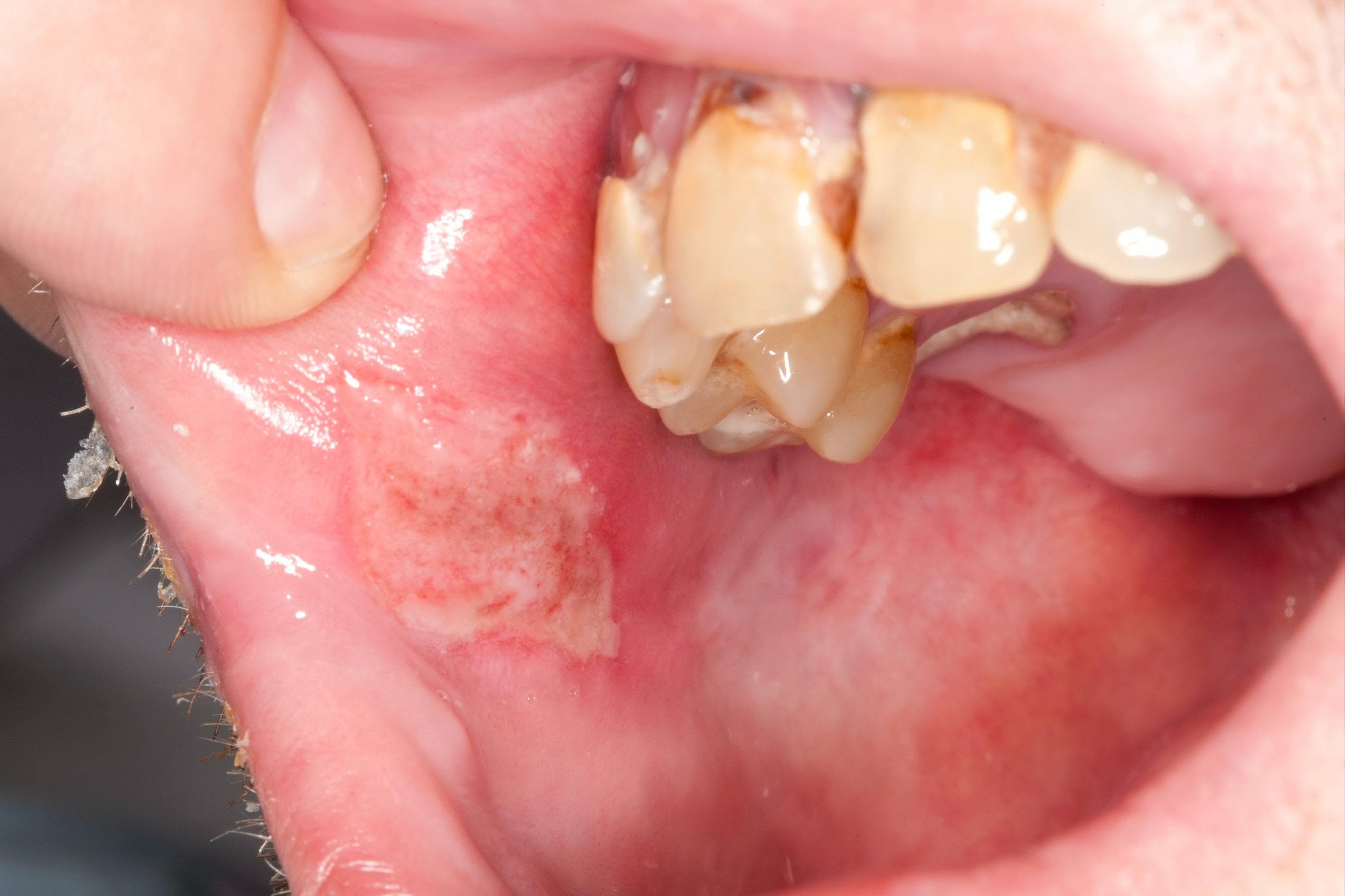 Large deep oral ulcer example