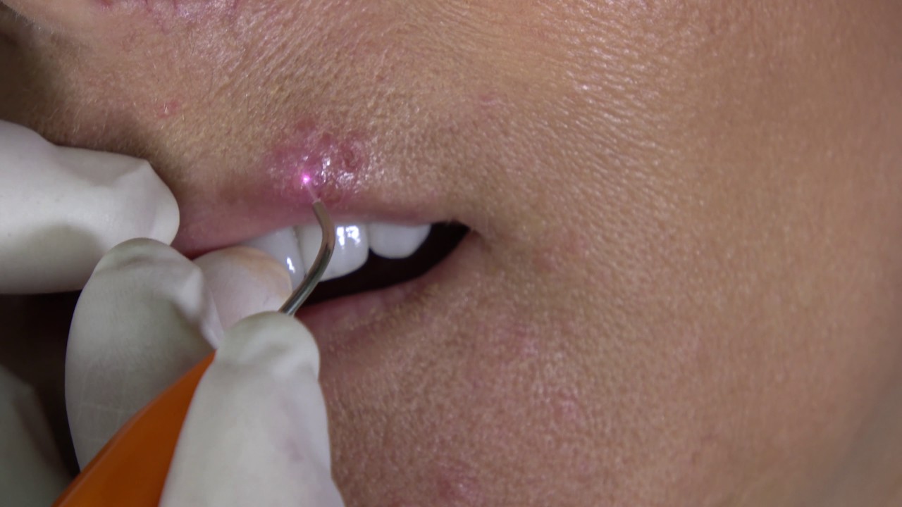 Dental laser used for soft-tissue treatment