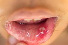 A typical canker sore on the inner lip